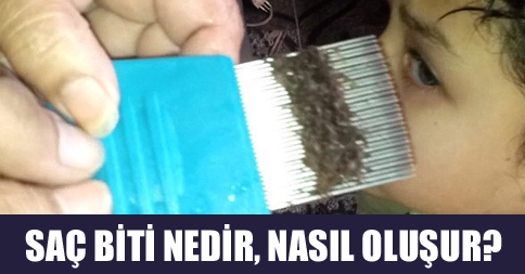 saç biti nedir nasıl oluşur